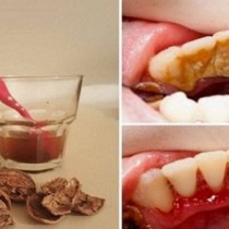 Как да премахнете зъбния камък и възпалението на венците с една съставка