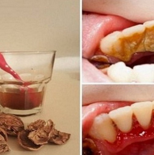 Как да премахнете зъбния камък и възпалението на венците с една съставка