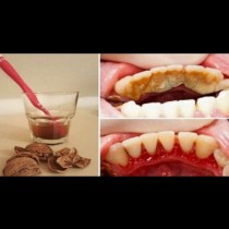 Отървете се от зъбната плака, зъбният камък и кървенето на венците по много прост и лесен начин без болка!