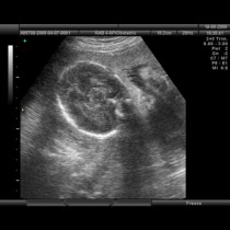 Тя била бременна с близнаци, но когато отишла на ултразвук сърцето й щяло да се пръсне от това, което й казали (Снимки)