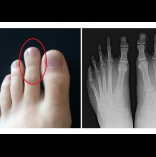 Вижте втория си пръст на крака: Ако имате тази дължина, то вие сте специални!