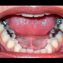 Болните зъби водят до рак!