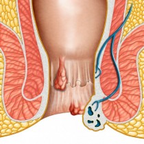 Златни съвети при кървящи хемороиди