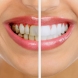 Забравете за зъболекаря и скъпите средства за избелване! С този домашен лек зъбите ви ще станат като на холивудска звезда (ВИДЕО)!