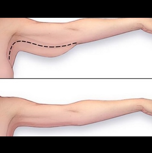 Как да елиминирате тлъстините по ръцете? 3 упражнения, които ще премахнат "прилеп-крилата" много бързо