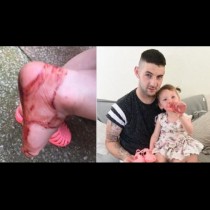 Той помогна на дъщеря си да се обуе и 30 минути по-късно краката й бяха подгизнали в кръв!