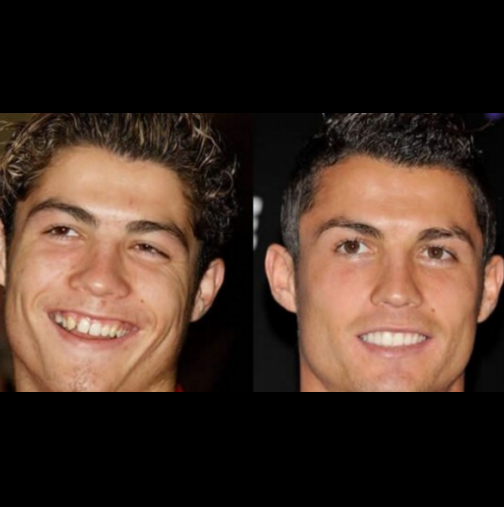 Преди и след: Шокиращи снимки на звездите преди да имат перфектна усмивка!