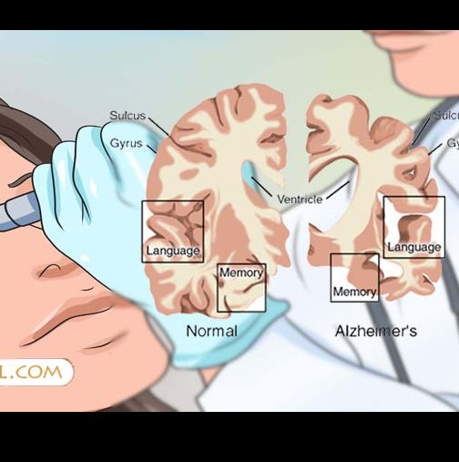 Този очен тест може да диагностицира Алцхаймер преди да имате симптоми