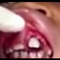 Момиче чувстваше нещо във венците, а зъболекарят изпадна в ужас, като видя!
