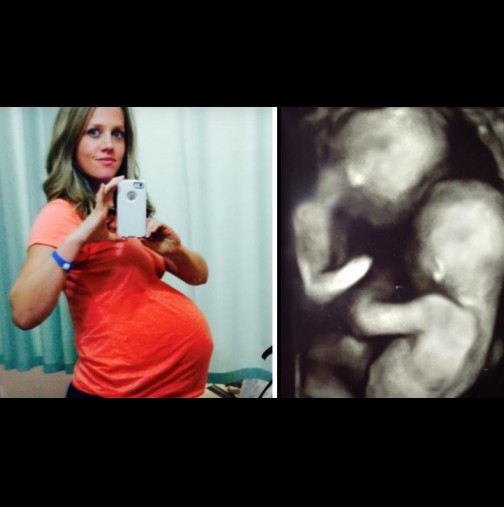 Тя е бременна с близнаци, но лекарите виждат нещо странно по време на ултразвука