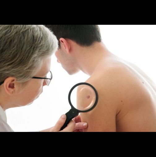 Учени разкриха причинител на рак на кожата