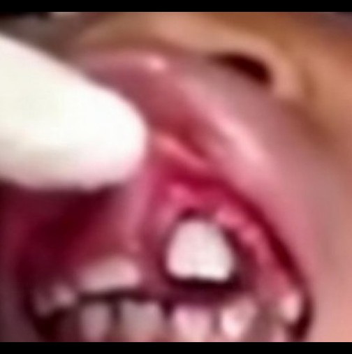Момиче чувстваше нещо във венците, а зъболекарят изпадна в ужас, като видя!