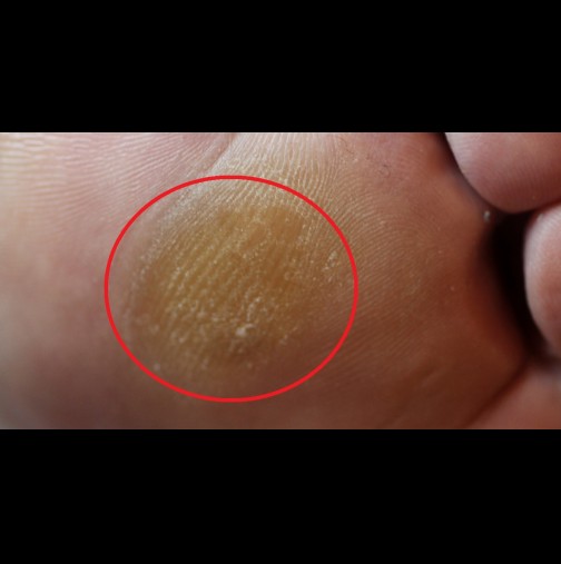 7 домашни техники за безболезнено справяне с мазолите - кожата става кадифена, а резултатите са смайващи!