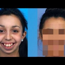 Всички й се подиграваха заради зъбите, но вижте две години по-късно!
