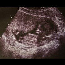 Лекарите им казват, че бебето ще се роди мъртво, но когато излиза на бял свят няма да повярвате какво се случва (Снимки)
