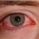 Как да лекуваме възпалени очи с природни средства