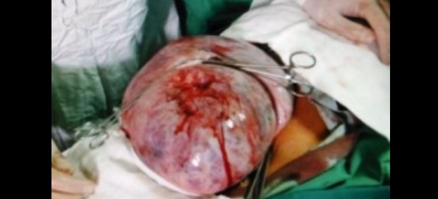Гигантски тумор с тегло 23 кг отстраниха лекарите в Майчин дом