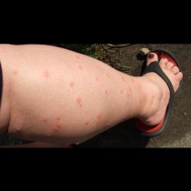 Най-големият ми летен кошмар: крака като решето от комарите! От кръвопийците и сърбежа ме избави прост домашен лосион: