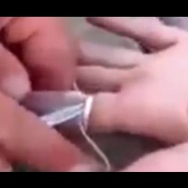 Лекарите предложиха да ѝ отрежат пръста, който вече беше посинял, златарят да среже пръстена, но ето как спасиха пръстена и пръста!