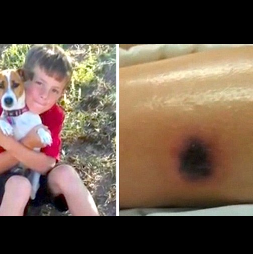 10-годишно момче получи странно петно на крака си. Лекарите не разпознаха причината и две седмици по-късно, то си отиде