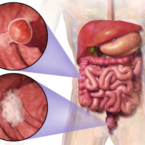 Първи признаци на рак на дебелото черво 