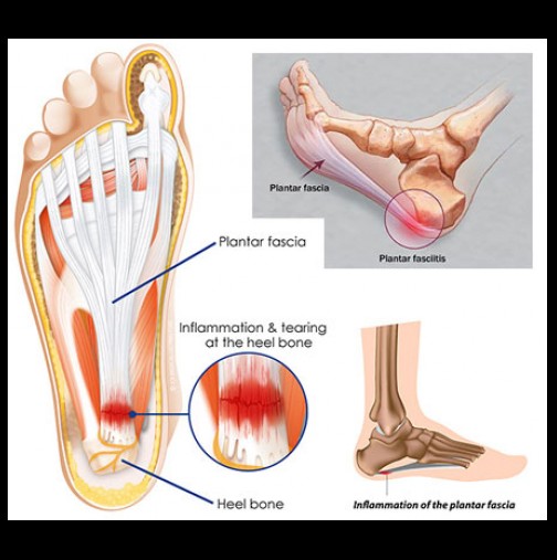 Усещали ли сте неприятни болки в петата? Ето на какво се дължат и как може да си помогнете