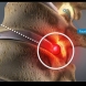 Най- добрата домашна рецепта за лечение на дискова херния за няколко дни!