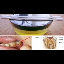 Зъбната болка изчезва светкавично: Това е най-добрият естествен лек за зъбобол!