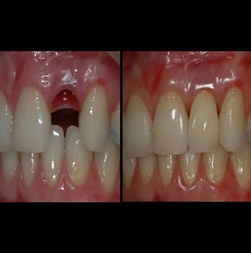 Нови зъби поникват в продължение на 9 седмици, процедура, която е възможна във всяка възраст!