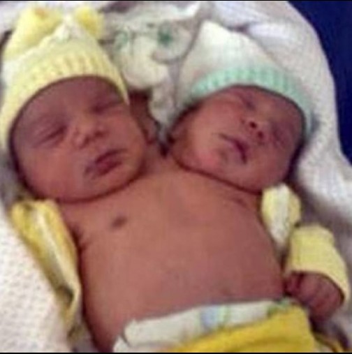 Помните ли близначките, които се родиха свързани. Вижте как изглеждат днес след цели 16 години (снимки)