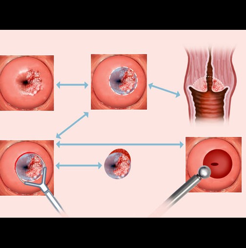 Първият симптом на рак на шийката на матката, при който трябва да ви светне червената лампичка