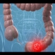 С тези знаци тялото ви идентифицира рак на дебелото черво 
