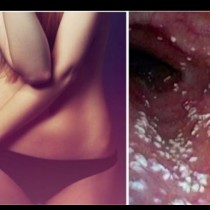 Всеки три от четири жени страдат от това! Какво е вагинална млечница и как да се излекувате?