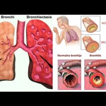 Силата на майката природа: Гони кашлица и бронхит по естествен път