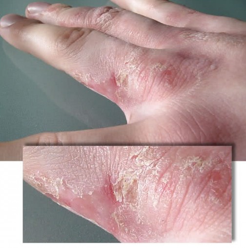 Започват безплатни прегледи за кожни и алергични заболявания