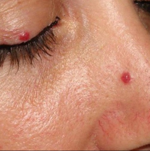 Имате ли такива червени точки по кожата? Ето какво трябва да знаете за тях