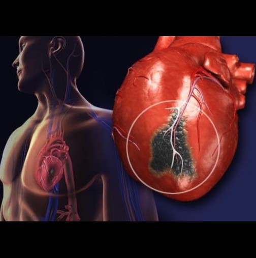 По какво се различава сърдечен пристъп, инфаркт и инсулт-Признаци