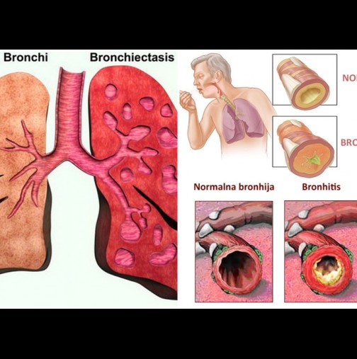 Силата на майката природа: Гони кашлица и бронхит по естествен път