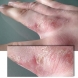 Започват безплатни прегледи за кожни и алергични заболявания