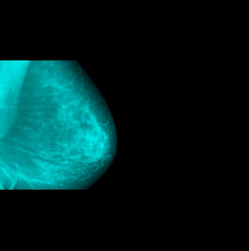 4 симптома на най-страшната болест, които нямат нищо общо с бучка или киста: това са най-ранните "предвестници" на рак на гърдата.
