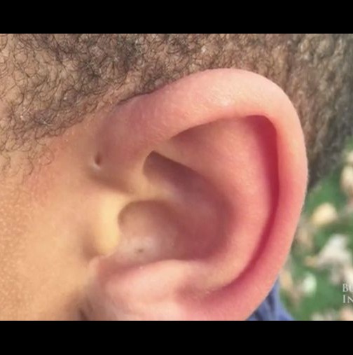 Някои хора са родени с дупки над ушите-Какво означава това?