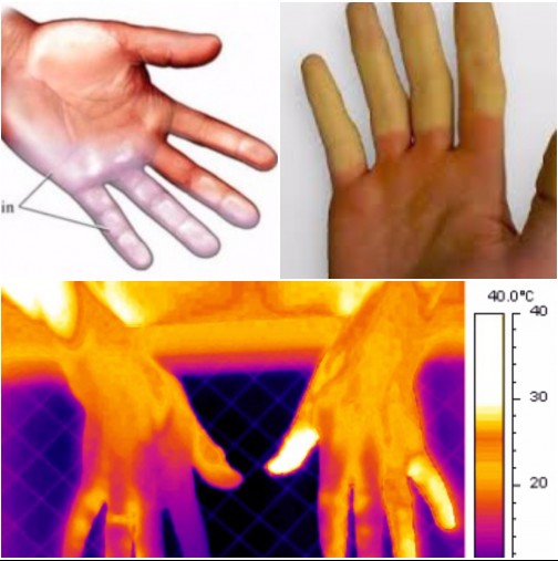 Не търкайте ръцете си, нито до печка или нагревател - Първа помощ при измръзване