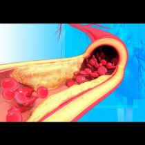 Време е да почистите артериите си и да предпазите сърцето си. Животът е пред вас, не си играйте с него
