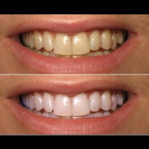 Естественото избелване на зъбите е на мода вече-Няма да ви болят зъбите една седмица, като при други методи