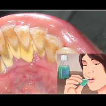 Зъболекарите са изумени! Вода за уста, която премахва плаката от зъбите за 1 минута!