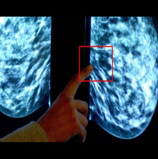 Учените откриха най-големият причинител на рака на гърдата! Приемаме го всеки ден