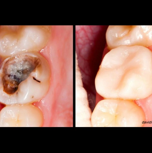 Зъбът може да бъде възстановен, а кариесът премахнат по естествен начин! 5 стъпки, да излекувате зъб
