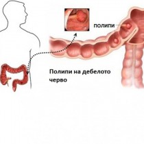 Полипи на дебелото черво: Симптоми и лечение!