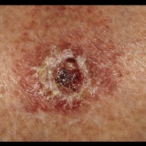3 предупредителни признака за рак на кожата, които нямат нищо общо с нова или изменена бенка!