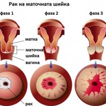 Ракът на маточната шийка е вторият по честота рак сред жените-Основна причина и как да се предпазим